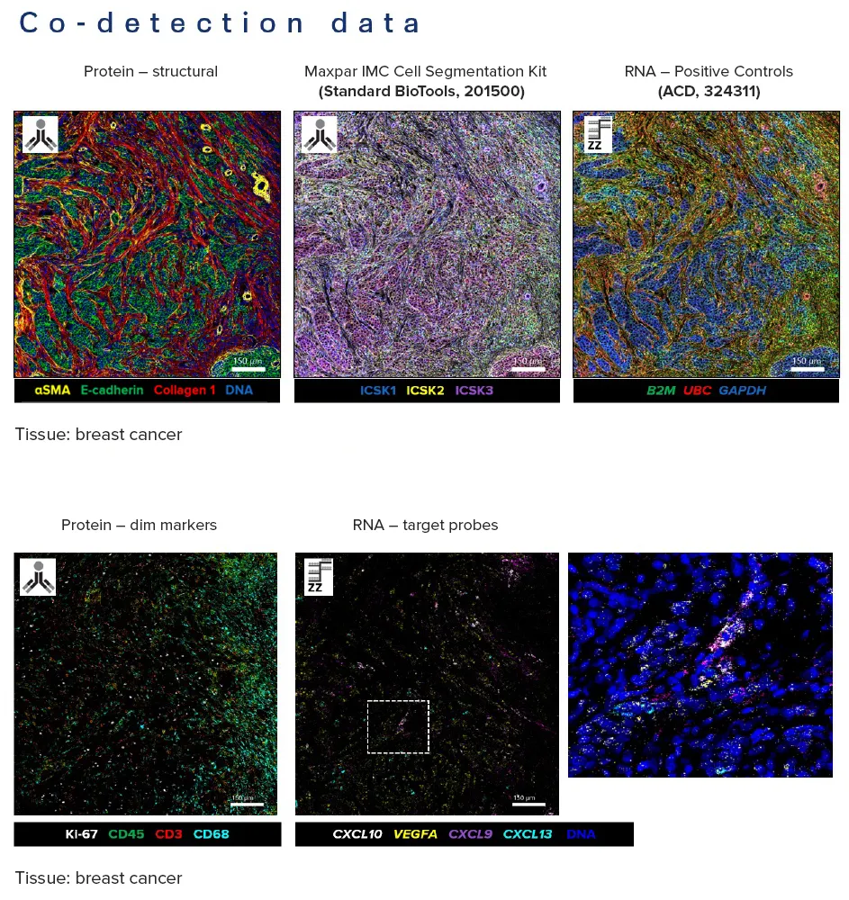 Breast cancer tissue. Co-detection data